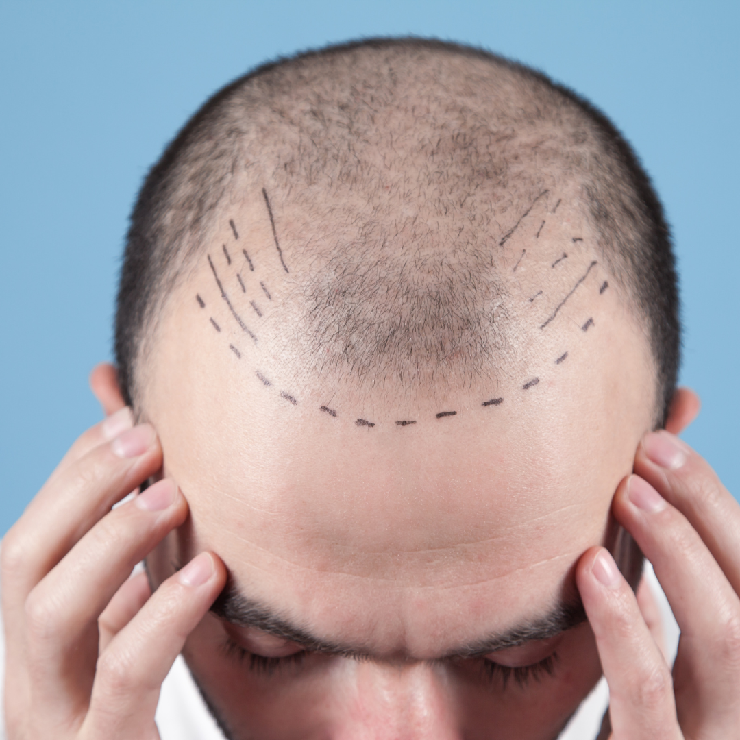 FUT Hair Transplantation