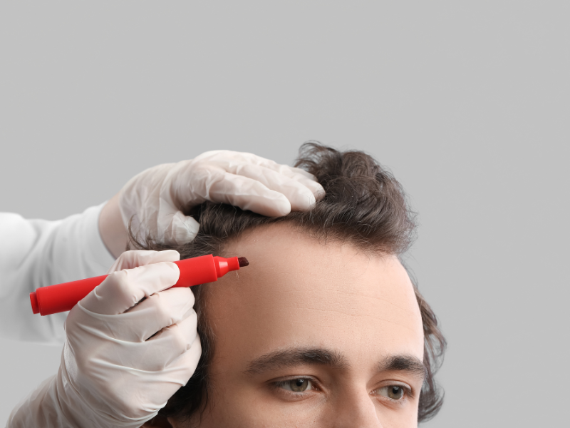 FUT Hair Transplantation