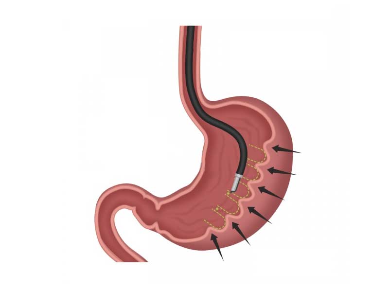 Endoscopic Sleeve Gastroplasty