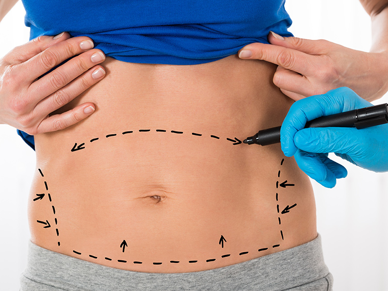 Tummy Tuck