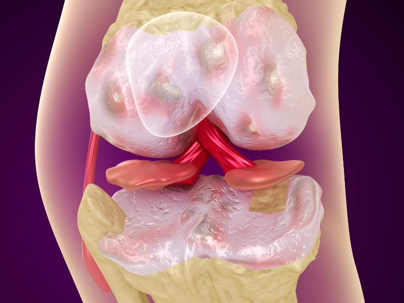 Osteoclasis