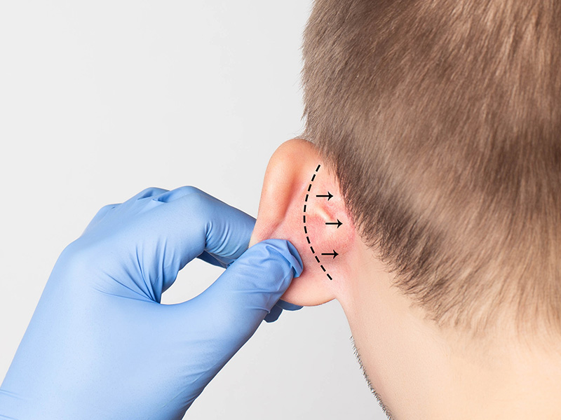 Otoplasty ( Ear Pinning ) Surgery