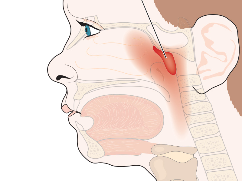 Adenoidectomy