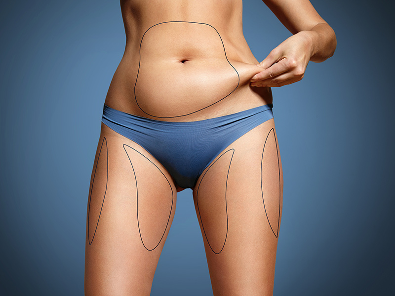 Liposuction